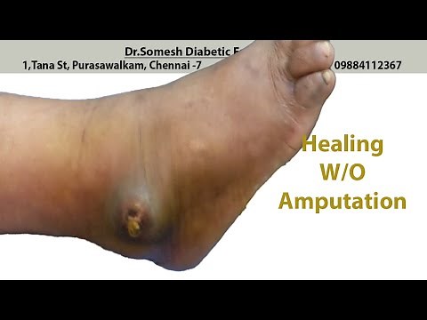 #Abscess Lateral Malleolus before after video