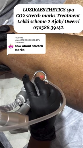 Replying to @user40109905635043 CO2 Laser Treatment: Your Solution for Stretch Marks & Skin Imperfections Whether it’s pregnancy stretch marks, wrinkles, scars, saggy skin, or keloids, CO2 laser helps by resurfacing the skin, stimulating collagen, and improving elasticity. The result? Smoother, tighter, younger-looking skin in just a few sessions. 💖 Some improvement may be visible after the first session, but multiple treatments are usually needed for long-lasting results. A consultation with o