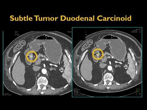 CT of the Small Bowel: Tumors Part 1
