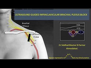 Ultrasound guided infraclavicular brachial plexus block