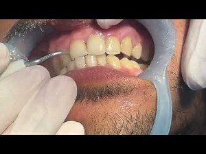 Scaling / dental scaling