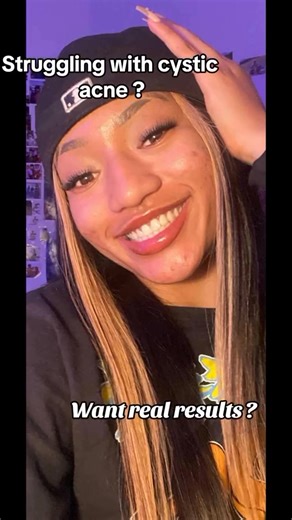 2.6K views · 11 reactions | Still struggling with cystic acne?  It’s time to get results you can actually see. Drop “link” in the comments ⬇️ and we’ll DM you the exact kit that clears acne, fades scars, and keeps your skin glowing ✨ #RichAndClear #AcneSolution #ClearSkinJourney #NoMoreBreakouts | Rich & Clear Skincare | Facebook