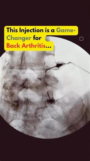 Tried Everything for ￼Back Arthritis?
