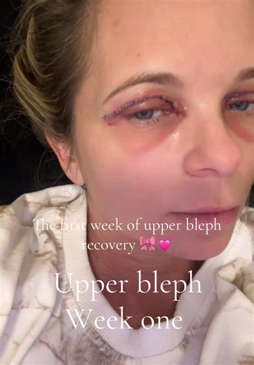 Upper Blepharoplasty Recovery: Week One Overview