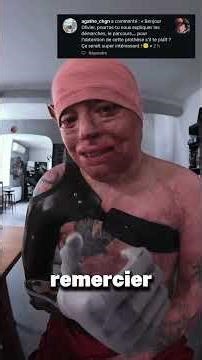 Beep beep beep, half man, half robot 🤖 #difference #burn #prosthesis #technology