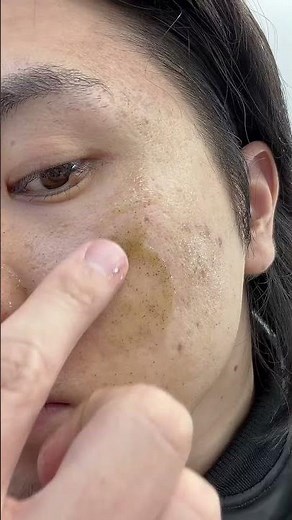 毛穴気になってたから、エステシャンの子が勧めてくれたハーブピーリング、試しに片側だけやってみたらめっちゃ綺麗になった！すごすぎるわ#毛穴 #メンズ美容 #垢抜け #スキンケア #ハーブピーリング pr