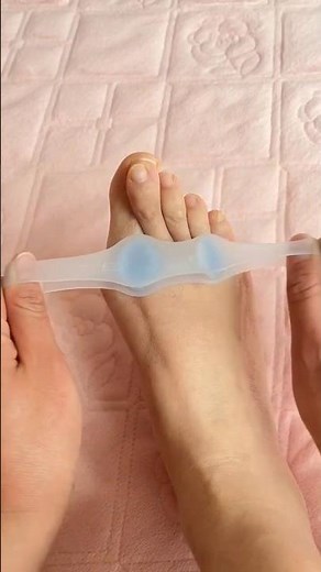 I Fixed My Bunion Naturally 😱 No Surgery Needed Shocking Results