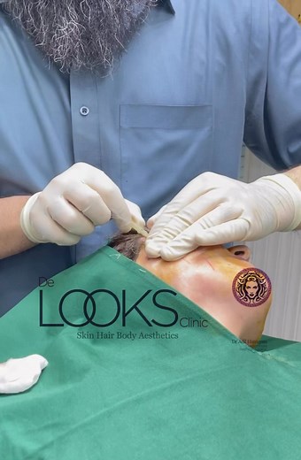 2K views · 13 reactions | A thread lift is a nonsurgical procedure...