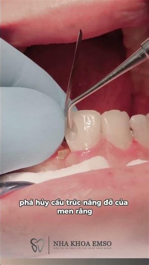 CÁI BẪY KHÔNG TƯỞNG CỦA NHỮNG CHẤM ĐEN VÔ HẠI #nhakhoaemso #chuyenrangnhaemso #dentist #ranghammat