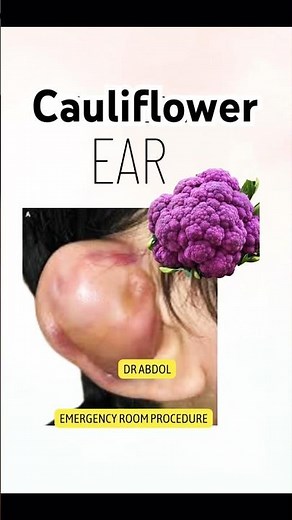 Complete Guide: #cauliflower #Ear Drainage and Proper #dressing