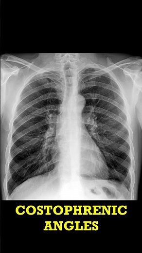 Chest X-Ray Findings Old Rib Fracture #radiology