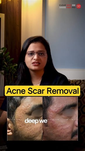 Before & After Acne Scar Removal That Actually Works #Shorts | Clear Skin Clinic, Pune