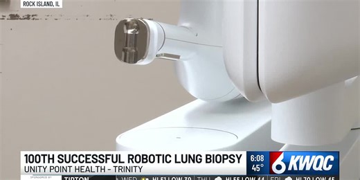 100th successful robotic lung biopsy at UnityPoint Health Trinity