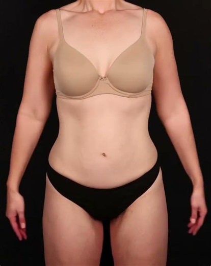 Before and After a Tummy Tuck