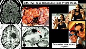 The Role of Intraoperative ECoG on the Identification of the Non-Visible Portion of Type II FCD: Sequential Electrocorticography to Tailor Resections