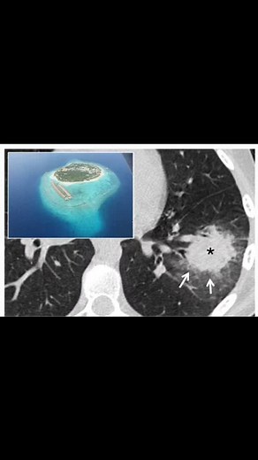 Shruthi P on Instagram: "Halo sign in a patient with angioinvasive aspergillosis: Round consolidation (black asterisk) with peripheral ground glass (white arrows), which suggests a hemorrhagic process. This ring or peripheral ground glass is similar to the sea’s appearance adjacent to an atoll #chestradiology #chestsign #pulmonary #ctscan #consolidation #medicalsigns #medicinestudent https://doi.org/10.1186/s13244-019-0789-4"