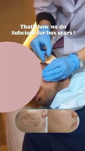 Subcision for Acne Scars Treatment in PWD Islamabad