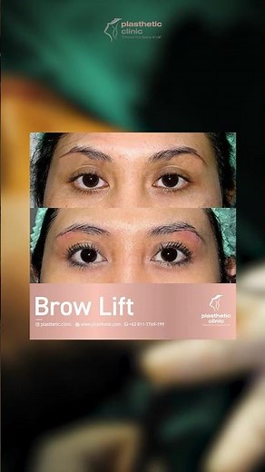 Brow Lift Surgery