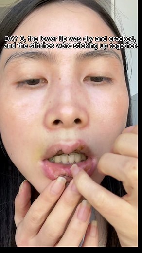 DAY 6 M lips, the lower lip skin is dry and cracked, the doctor's sutures are rolled up, a little uncomfortable, want to snap off by themselves🥹🥹🥹