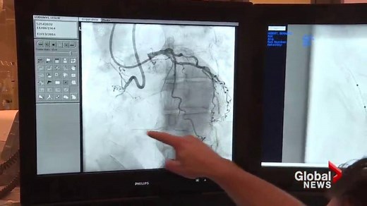 MUHC first to try catheter procedure