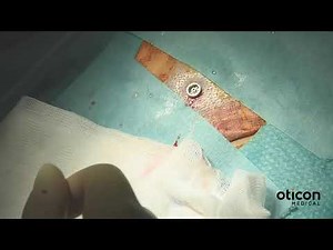 Oticon Medical MONO Procedure Video