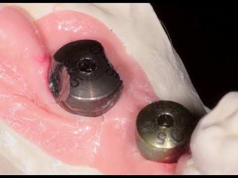 Healing Abutment is Stuck!