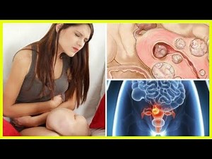 5 données sur les fibromes utérins à connaître à tout prix