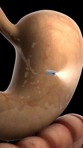 Job to Robot | Swallow the Future of Medical Exams 💊🤖 No tubes. No anesthesia. No pain. China’s AI-powered capsule completes a full gastric examination... | Instagram