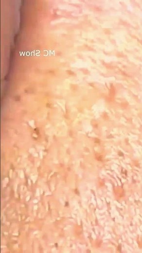 Pimple Popping Blackheads, Acne & Blackheads Removal 30