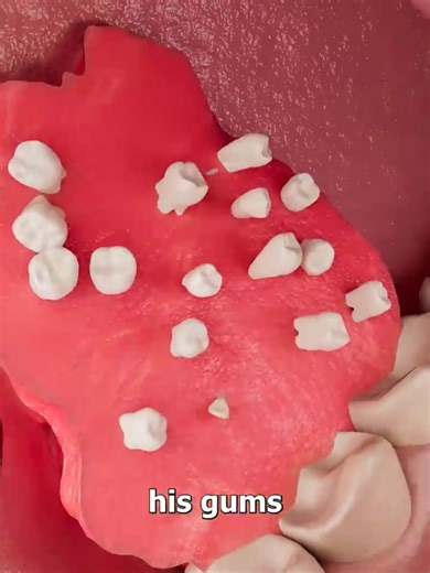 Boy's Jaw Tumor Grew Over 500 Teeth