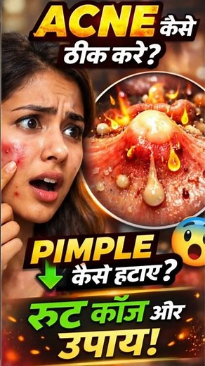 Acne Kaise Thik Kare? 😱 | Pimple Kaise Hataye Fast | Root Cause + Ayurvedic Solution #acnetreatment