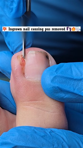 Nail Art on Instagram: "💉 Bye bye infected nail 🦶💊🔥 #trending #viral #healthtips #footcare"