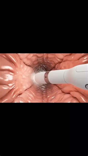 Upper Endoscopy Procedure – Watch the Complete 3D Demonstration!