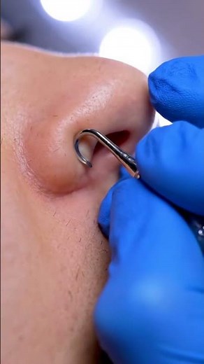 Satisfying Nose Crease Cleaning 👃✨