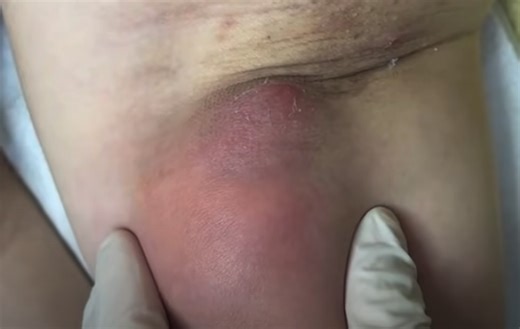 Large Abscess Underarm Incision and Drainage