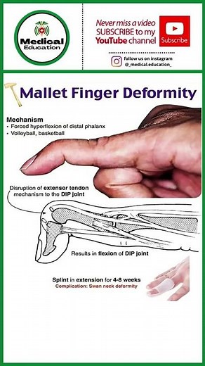 Mallet finger ddeformity