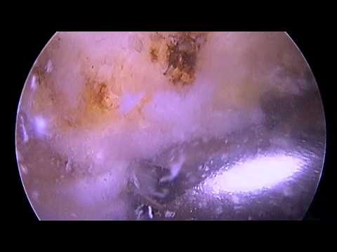 Arthroscopic Subacromial Decompression: Spur Removal