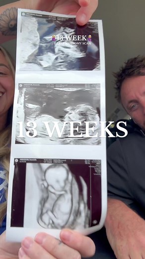 13 Weeks Pregnant: Early Anatomy Scan Experience