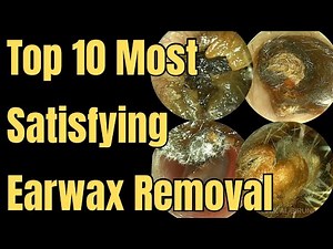 Top 10 Most Satisfying Earwax Removal