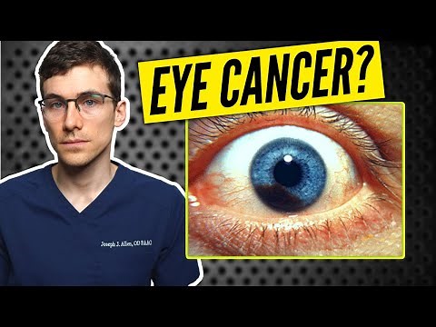 Eye Cancer? Eye Freckle Vs Melanoma of the Eye