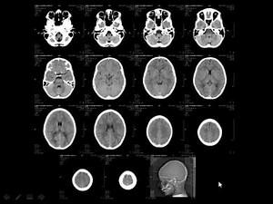 Radiology - Normal brain anatomy - CT and MRI