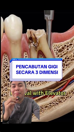 Pencabutan Gigi: Teknik Aman dan Tanpa Rasa Sakit