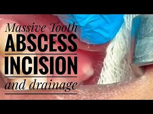 Massive dental abscess | huge popping dental abscess |incision &drainage