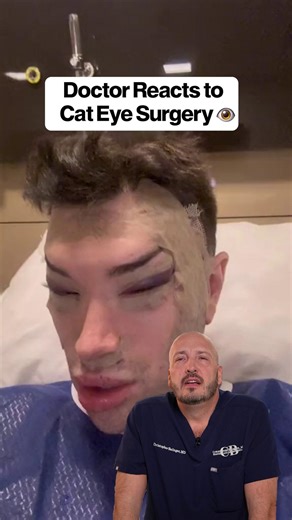 1.9K views · 4 comments | That cat eye surgery is intense  #plasticsurgery #cateyesurgery #plasticsurgeon #shocking #meded #aesthetics | Beauty By Balinger | Facebook