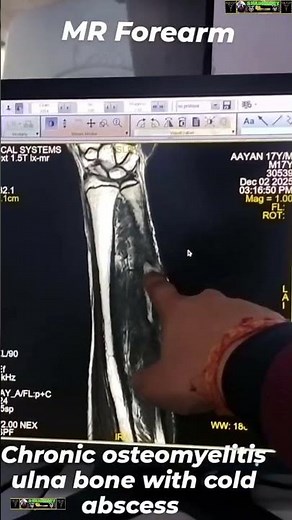 MRI FOREARM #anatomy