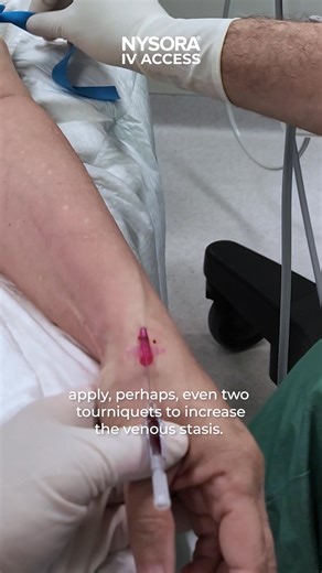 Struggling with rolling veins? Watch how proper preparation turns a difficult IV into a smooth success! - Double tourniquets - Low-angle entry - Patience = easy access Find more practical tips in the NYSORA IV Access App. Designed to support you in mastering difficult IV access, step by step. https://community.nysora.com/IV-Access-App-IG | NYSORA - Continuing Medical Education