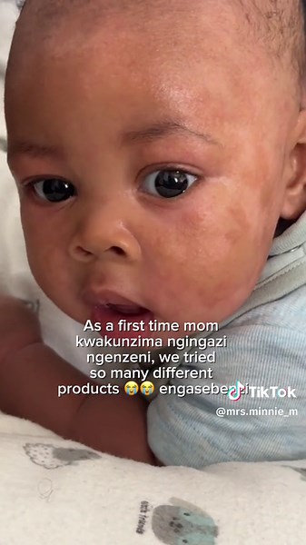 Effective Ways to Manage Baby Eczema Naturally