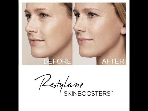 Restylane SkinBoosters Vital Face Treatment in Bristol