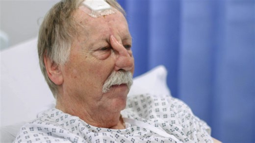 Watch man have ‘elephant's trunk’ nose reconstructed after cancer ravaged face