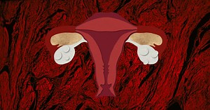 Qu'est-ce que l'adénomyose, cette forme d'endométriose interne peu connue ?